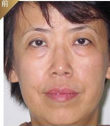 豪门阔太做超 声 波去眼袋找回青春靓丽 豪门阔太做超 声 波去眼袋找回青春靓丽