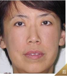 豪门阔太做超 声 波去眼袋找回青春靓丽 豪门阔太做超 声 波去眼袋找回青春靓丽