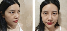 超 声 波去眼袋后大眼妹又再现le! 超 声 波去眼袋后大眼妹又再现le!