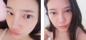 超 声 波去眼袋后大眼妹又再现le! 超 声 波去眼袋后大眼妹又再现le!