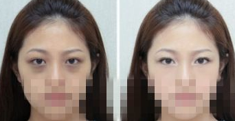 超声波去眼袋帮我守住我的家841 超声波去眼袋帮我守住我的家841