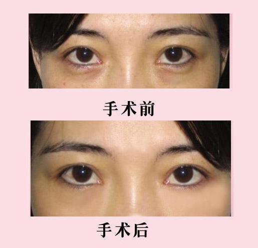 男友不断夸我做超声波去眼袋让他很惊喜296 男友不断夸我做超声波去眼袋让他很惊喜296