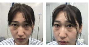 超声波去眼袋解决年轻人的眼袋困扰540 超声波去眼袋解决年轻人的眼袋困扰540