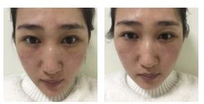 超声波去眼袋解决年轻人的眼袋困扰540 超声波去眼袋解决年轻人的眼袋困扰540
