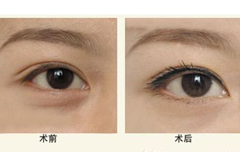 去眼袋,看看我的效果就懂了814 去眼袋,看看我的效果就懂了814