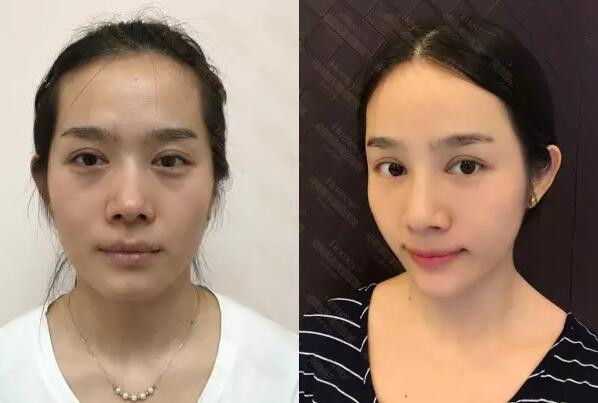为什么你去不掉眼袋?320 为什么你去不掉眼袋?320