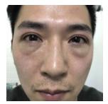 超声波去眼袋提升了我的形象795 超声波去眼袋提升了我的形象795