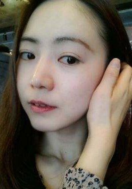 刚做超 声 波双眼 皮得小美女给大家分享 刚做超 声 波双眼 皮得小美女给大家分享