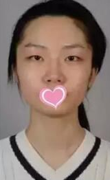 因为超声波双眼皮现在的我有了一双美丽的大眼睛148