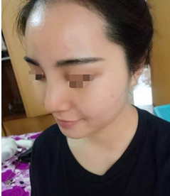 不开刀隆鼻让我变成拍照达人499 不开刀隆鼻让我变成拍照达人499