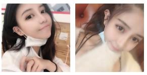 超声波双眼皮的效果确实很棒668 超声波双眼皮的效果确实很棒668