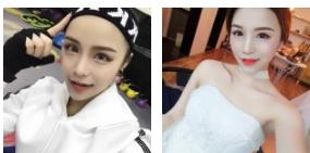 超 声 波双眼 皮术后ー年有感 超 声 波双眼 皮术后ー年有感