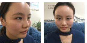 超 声 波双眼 皮让眼睛做改变 超 声 波双眼 皮让眼睛做改变