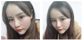 超 声 波双眼 皮让眼睛做改变 超 声 波双眼 皮让眼睛做改变