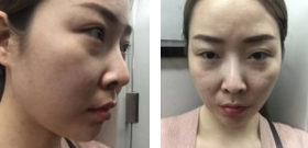 能给你带来正能量的眼袋消除术——超声波去眼袋579
