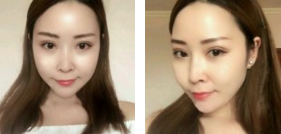 能给你带来正能量的眼袋消除术——超声波去眼袋579