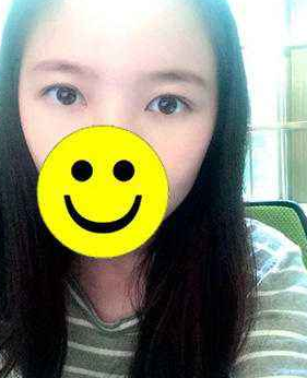 wǒ偷偷在变美 全靠超 声 波去眼袋 wǒ偷偷在变美 全靠超 声 波去眼袋