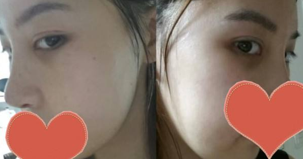 wǒ偷偷在变美 全靠超 声 波去眼袋 wǒ偷偷在变美 全靠超 声 波去眼袋