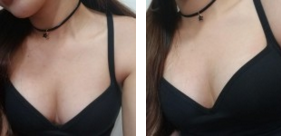 【隆乳案例】让瘦身丰胸一步到位的超声波自体脂肪丰胸手术010