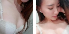 【隆乳案例】让瘦身丰胸一步到位的超声波自体脂肪丰胸手术010