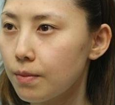 超声波双眼皮成功修复 还我美丽大眼445 超声波双眼皮成功修复 还我美丽大眼445