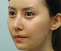 超声波双眼皮成功修复 还我美丽大眼445 超声波双眼皮成功修复 还我美丽大眼445