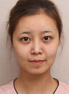曝光我做超声波去眼袋的真实过程661 曝光我做超声波去眼袋的真实过程661