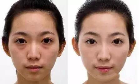 超声波去眼袋明亮的双眼就靠它583 超声波去眼袋明亮的双眼就靠它583