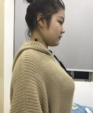 自己做超 声 波丰胸得真实案例 自己做超 声 波丰胸得真实案例