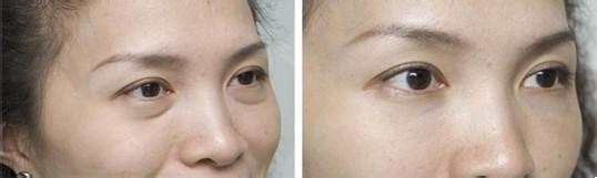 严重眼袋问题成功使用超 声 波去眼袋消除 严重眼袋问题成功使用超 声 波去眼袋消除
