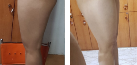 【吸脂瘦大腿】超声波减肥让大腿苗条了572 【吸脂瘦大腿】超声波减肥让大腿苗条了572