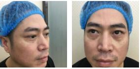 男人也需要做超声波去眼袋954 男人也需要做超声波去眼袋954