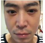 男人也需要做超声波去眼袋954 男人也需要做超声波去眼袋954