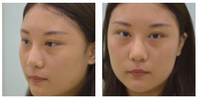 老妈超给力带我做了超声波去眼袋510 老妈超给力带我做了超声波去眼袋510