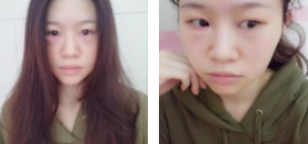 看咱们做得超 声 波去眼袋,恢复不错哦 看咱们做得超 声 波去眼袋,恢复不错哦