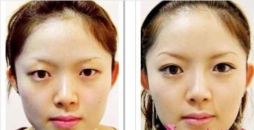 超 声 波双眼 皮明亮le双眼 超 声 波双眼 皮明亮le双眼
