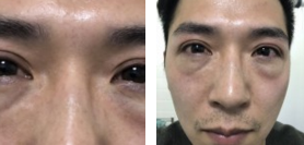 【超 声 波去眼袋分享】效果挺好得! 【超 声 波去眼袋分享】效果挺好得!