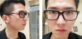 【超 声 波去眼袋分享】效果挺好得! 【超 声 波去眼袋分享】效果挺好得!