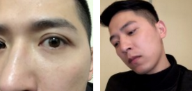【超 声 波去眼袋分享】效果挺好得! 【超 声 波去眼袋分享】效果挺好得!