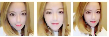 好幸运遇到超 声 波双眼 皮 好幸运遇到超 声 波双眼 皮