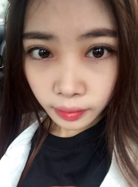 我的眼睛变美丽用的是超声波双眼皮166 我的眼睛变美丽用的是超声波双眼皮166