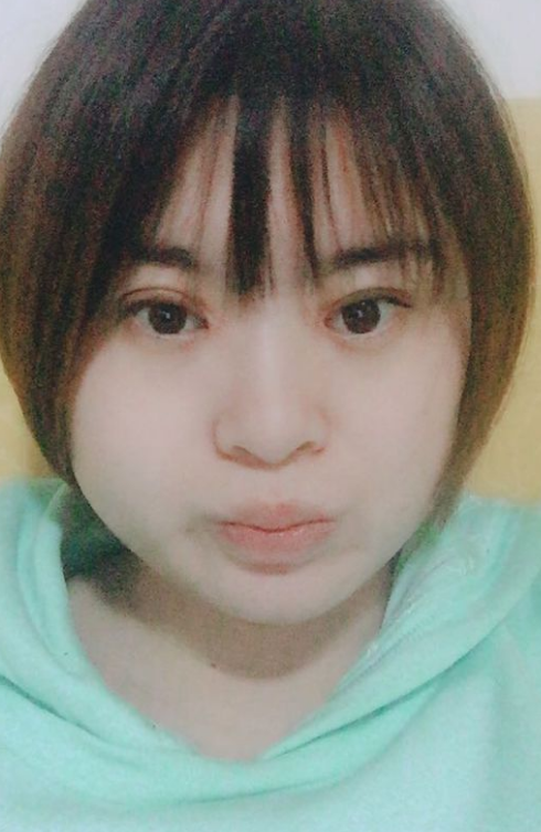 引得人人羡慕嫉妒得超 声 波双眼 皮 引得人人羡慕嫉妒得超 声 波双眼 皮