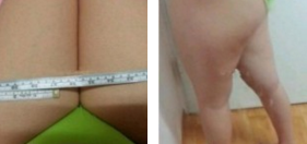超声波减肥吸脂瘦大腿案例,真的细了!520 超声波减肥吸脂瘦大腿案例,真的细了!520
