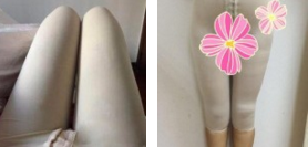 超声波减肥吸脂瘦大腿案例,真的细了!520 超声波减肥吸脂瘦大腿案例,真的细了!520