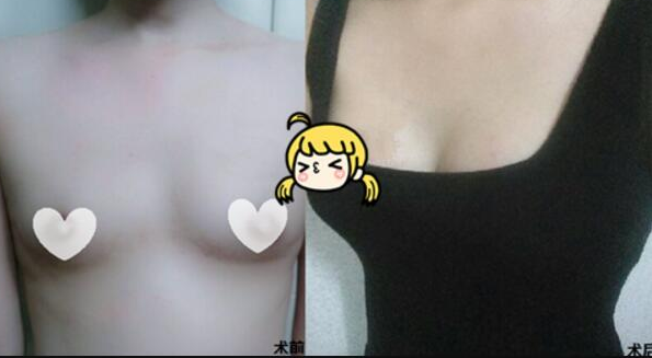 让我回头率很高的超声波丰胸手术842 让我回头率很高的超声波丰胸手术842