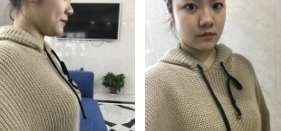 超声波自体脂肪丰胸让我更加丰满654 超声波自体脂肪丰胸让我更加丰满654