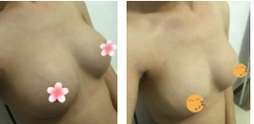 超声波自体脂肪丰胸效果不错，恢复的越来越好了004