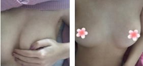 超声波自体脂肪丰胸一个月，大家看看效果如何？099