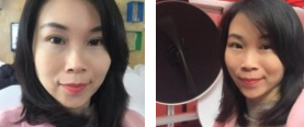 去掉眼袋，眼睛漂亮许多！感谢超声波去眼袋手术！873