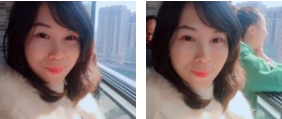 去掉眼袋，眼睛漂亮许多！感谢超声波去眼袋手术！873